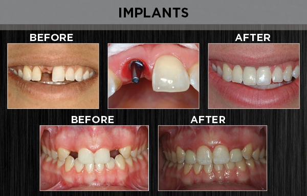 prosthodontics - implants